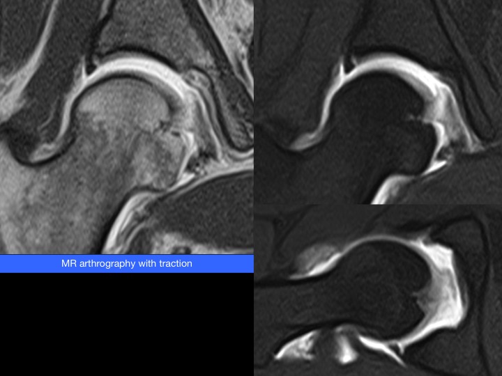 Figure 2 for case ligamentum teres of femoral head ( RID2653 )